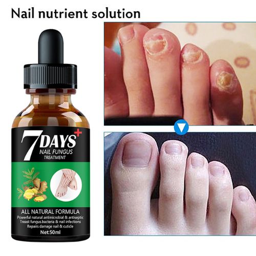 Serum för behandling av fot- och nagelsvamp